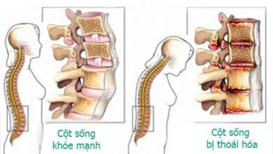 Cột sống thoái hóa