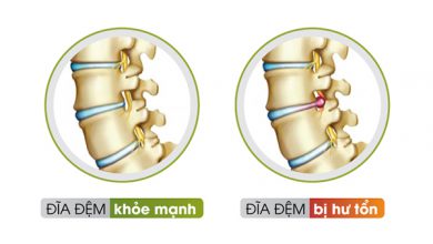 Đĩa đệm bị hư tổn sẽ gây chèn ép đến các rễ thần kinh xung quanh