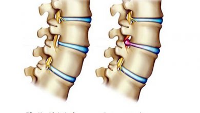 Bệnh thoát vị đĩa đệm