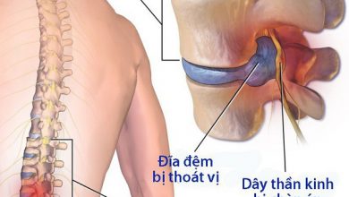 Bệnh thoát vị đĩa đệm cột sống thắt lưng