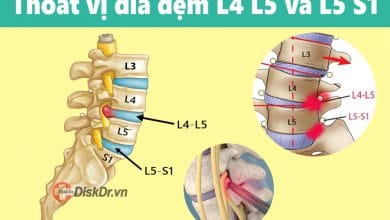 Thoát vị đĩa đệm L4 L5 và L5 S1