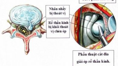 Phẫu thuật lấy khối thoát vị đĩa đệm