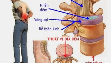 Bệnh thoát vị đĩa đệm