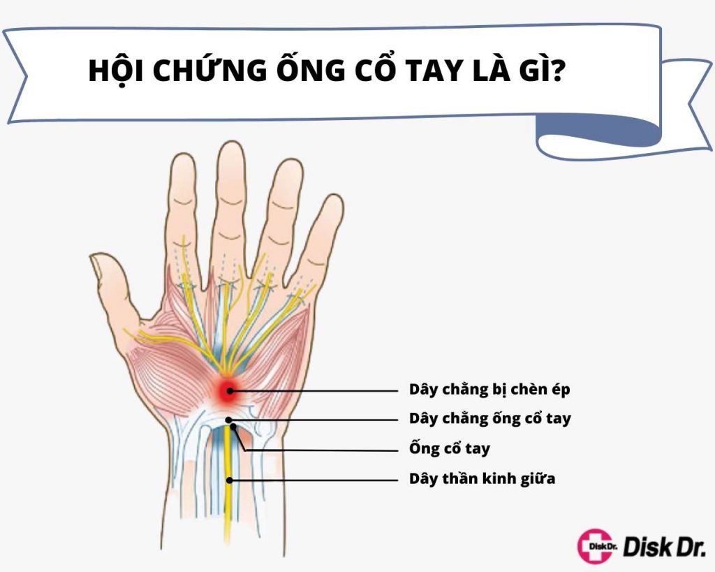 Hội chứng ống cổ tay là gì? Nguyên nhân, triệu chứng, và cách điều trị