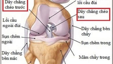 Biến chứng từ đứt dây chằng chéo trước